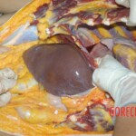 Autopsy of young girl