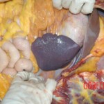 Autopsy of young girl