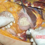 Autopsy of young girl