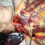 Autopsy of young girl