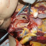 Autopsy of young girl