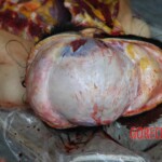 Autopsy of young girl