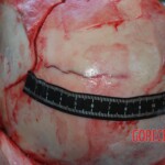 Autopsy of Chinese female