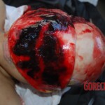 Autopsy of Chinese female