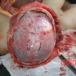 Autopsy of Chinese female