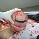 Autopsy of Chinese female