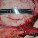 Autopsy of Chinese female