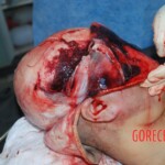 Autopsy of Chinese female