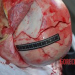 Autopsy of Chinese female