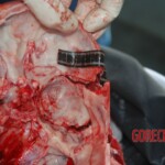 Autopsy of Chinese female