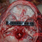 Autopsy of Chinese female