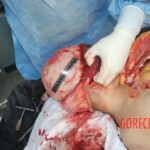 Autopsy of Chinese female