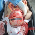 Autopsy of Chinese female