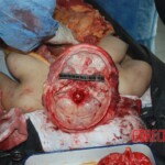 Autopsy of Chinese female