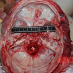 Autopsy of Chinese female