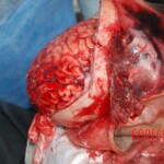 Autopsy of Chinese female