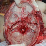 Autopsy of Chinese female