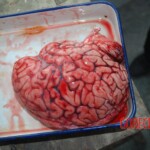 Autopsy of Chinese female