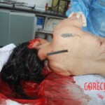 Autopsy of Chinese female