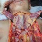 Autopsy of Chinese female