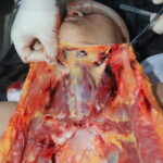 Autopsy of Chinese female