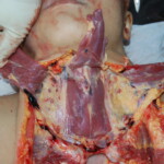 Autopsy of Chinese female