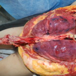 Autopsy of Chinese female