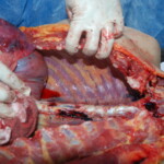 Autopsy of Chinese female