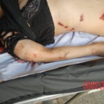 Autopsy of Chinese female