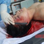 Autopsy of Chinese female