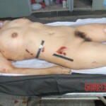 Autopsy of Chinese female