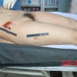 Autopsy of Chinese female