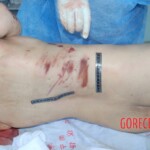 Autopsy of Chinese female