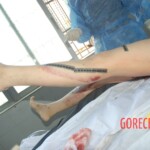 Autopsy of Chinese female