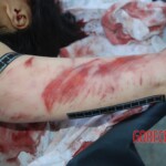 Autopsy of Chinese female