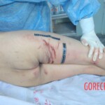 Autopsy of Chinese female