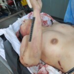 Autopsy of Chinese female