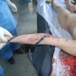 Autopsy of Chinese female