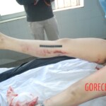 Autopsy of Chinese female