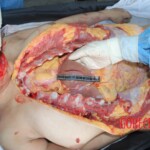 Autopsy of Chinese female