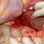 Autopsy of Chinese female