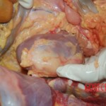 Autopsy of Chinese female