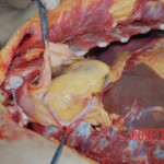 Autopsy of Chinese female