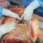 Autopsy of Chinese female