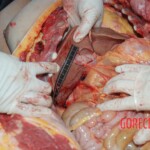 Autopsy of Chinese female