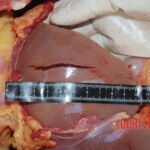 Autopsy of Chinese female