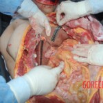Autopsy of Chinese female