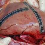 Autopsy of Chinese female