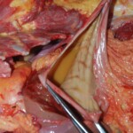 Autopsy of Chinese female