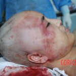 Autopsy of Chinese female